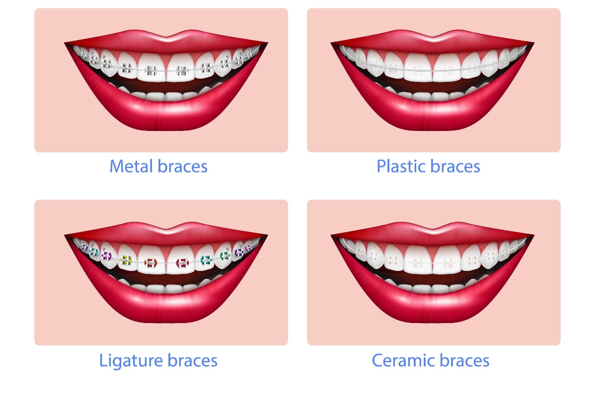 Types of braces